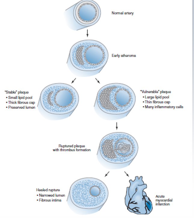 ateroscleroza picioarelor i varicozei